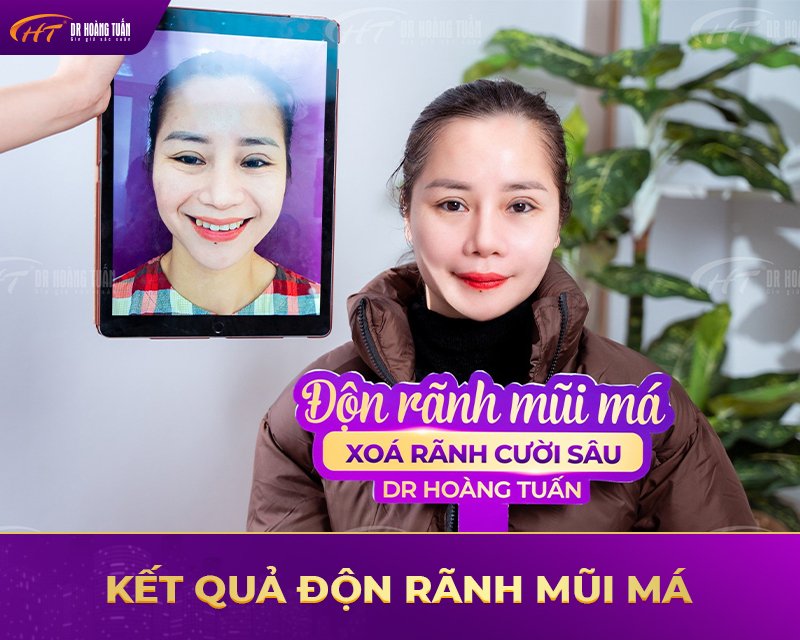 Một số kết quả độn rãnh mũi má tại Dr Hoàng Tuấn 3